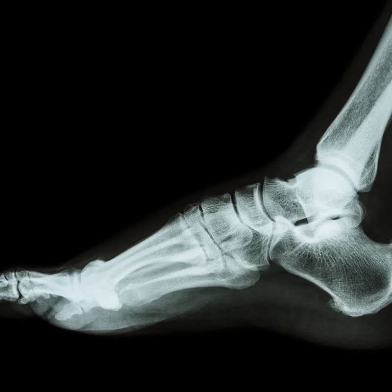 Foot Fractures And Disorders In Philadelphia, Pa 